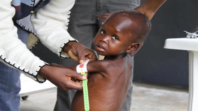 malnutrition-in-nigeria-1