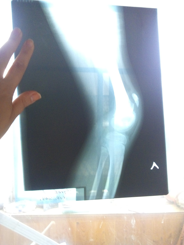 левое колено