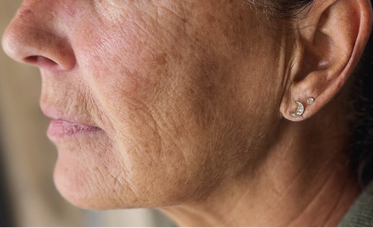 Perte de fermeté et élasticité - Résultats soin Jouvence