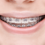 Metal Braces