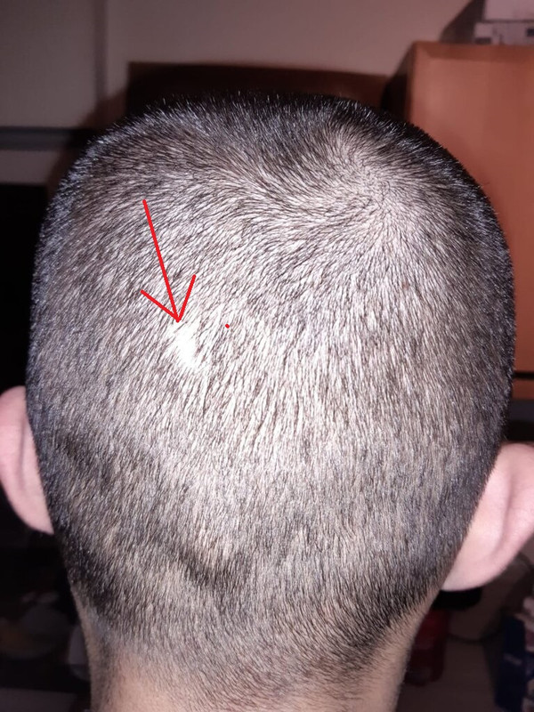 scalp.jpg