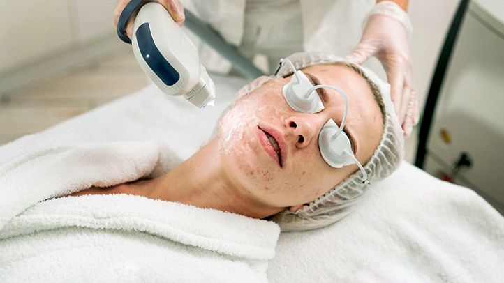 laser treatment for acne scarring
