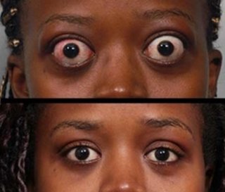 Thyroid-Eye-Photo-300x256-1.jpg