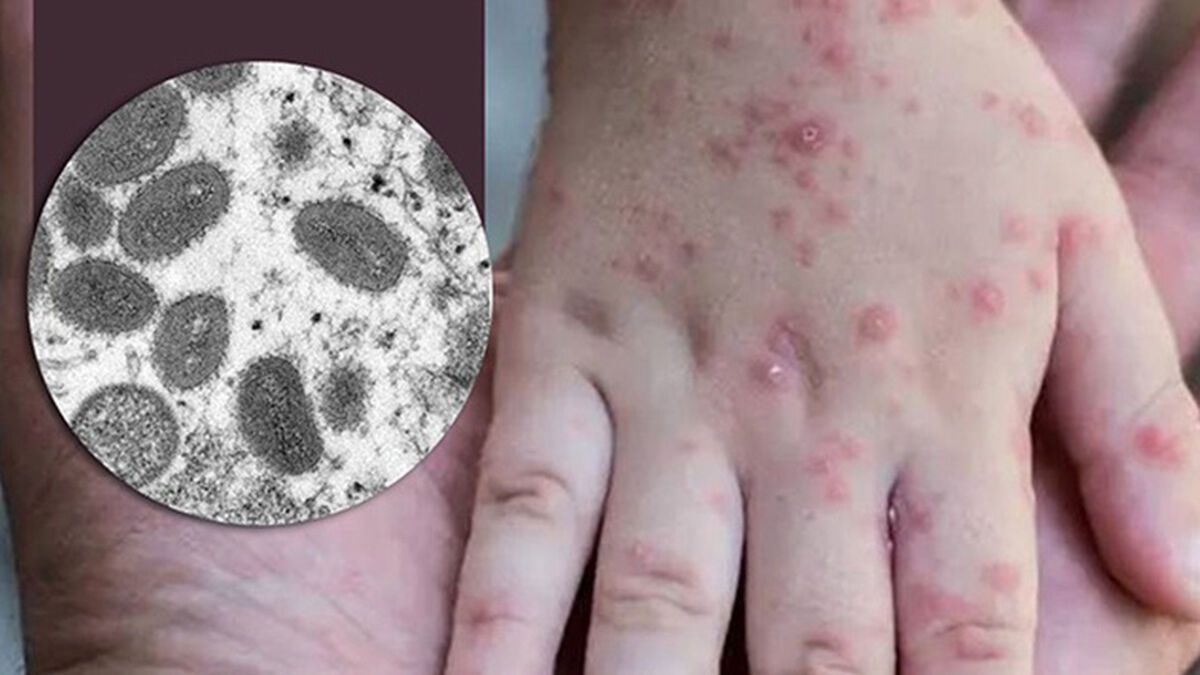 Vacunación masiva contra la viruela del mono no es recomendable; OMS