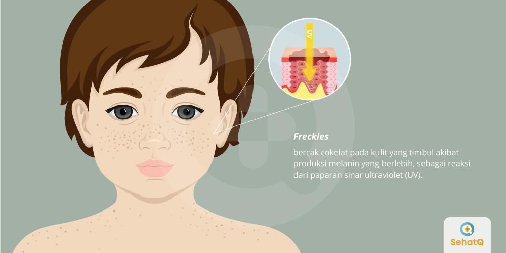 Ilustrasi freckles