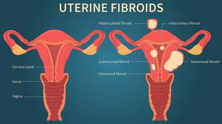 How to stop fibroids from growing