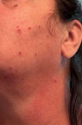 sudden-itchy-bumps-on-face-that-fill-with-clear-fluid-and-v0-8x5fcy91dztg1