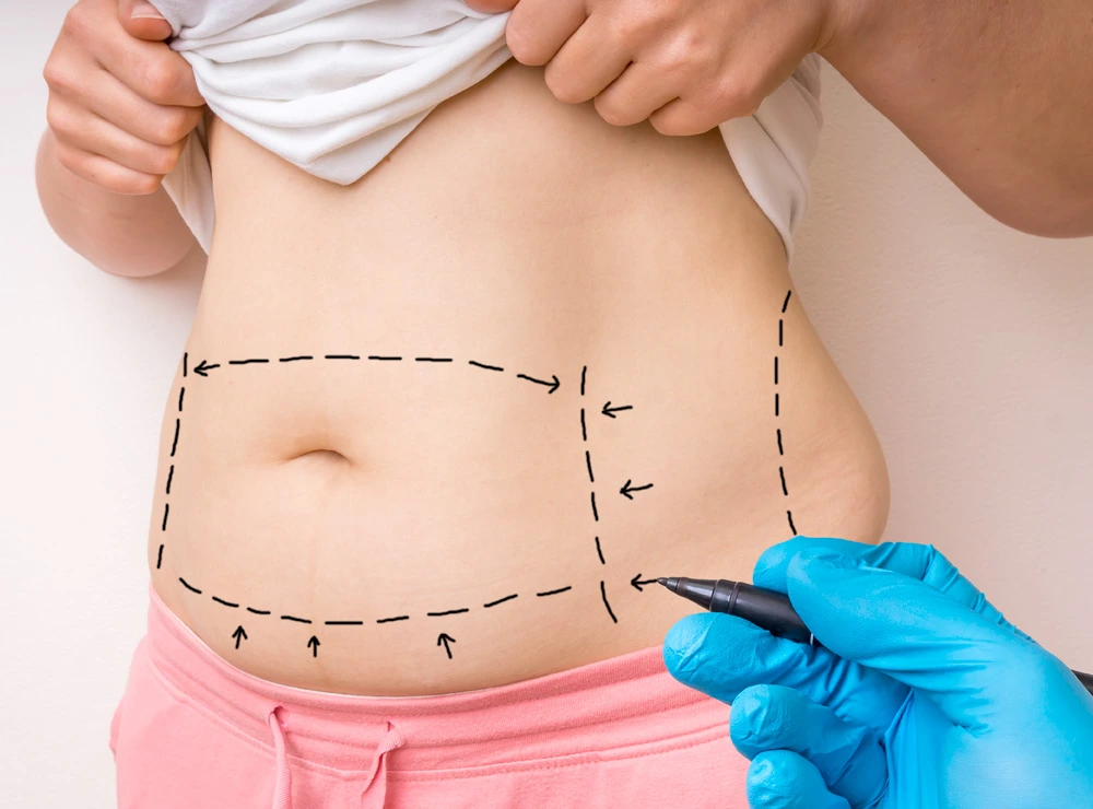 mini tummy tack dubai