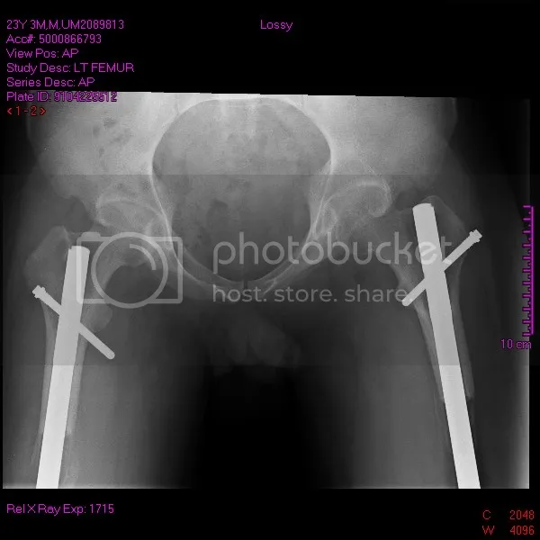 Surgeons who are CAREFUL about the length of their screws?