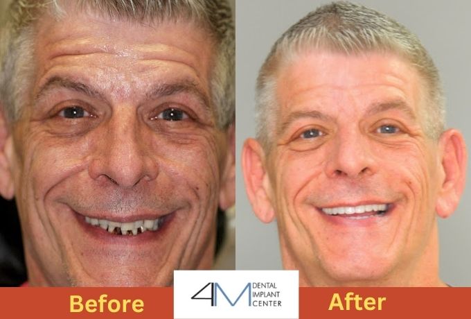 Before and after photos of a man showcasing a bright smile, highlighting a positive transformation in his appearance.