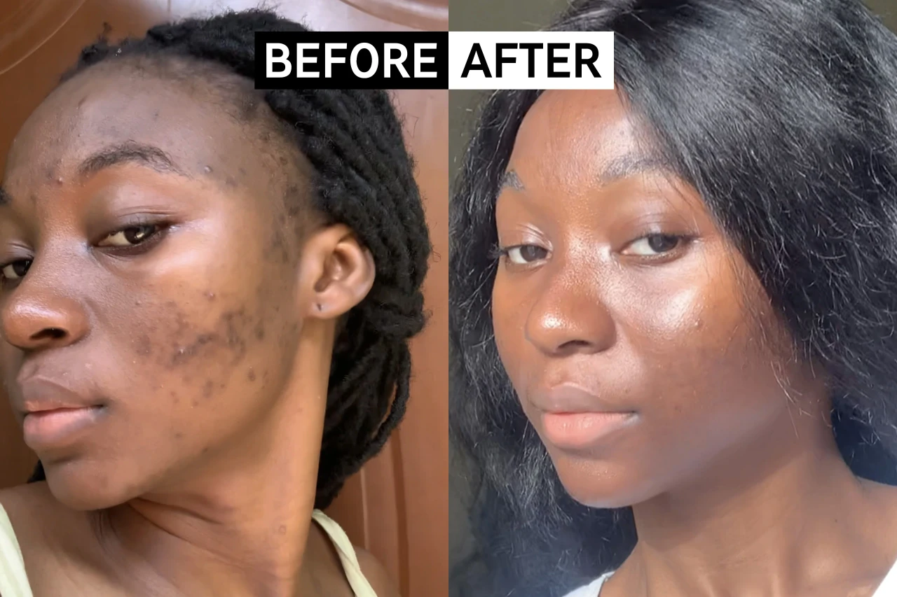 Acne scars before and after