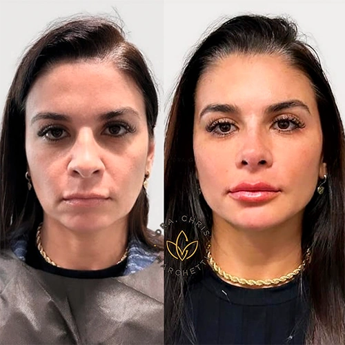 Preenchimento Labial