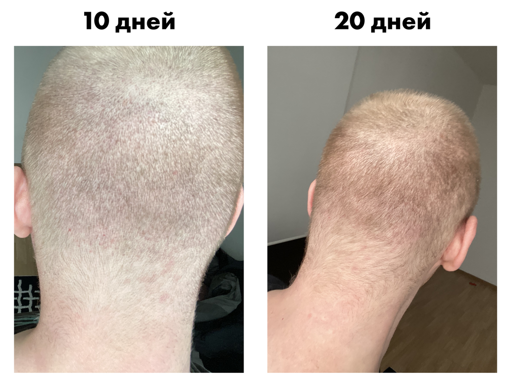 Бебуришвили до и после пересадки волос. Пересадка волос горного козла. После пересадки волос 2 недели спустя.