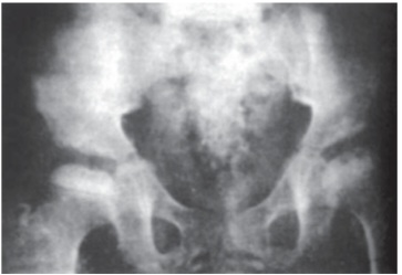 Hip X-ray showing epiphyseal dysgenesis of the femoral head in congenital hypothyroidism