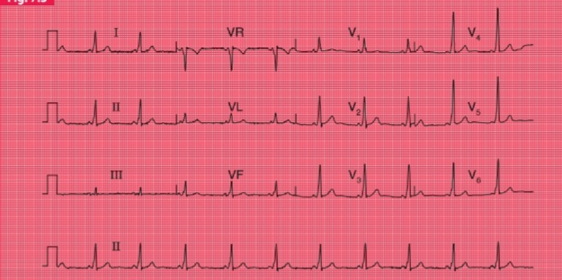 ECG showing Wolff-Parkinson-White Syndrome – short PR interval, delta wave, wide QRS