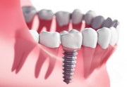 Implantate