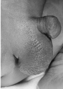 Chordee - downward curvature of the penis with normally located urethral meatus