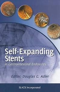 Self-Expanding Stents in Gastrointestinal Endoscopy