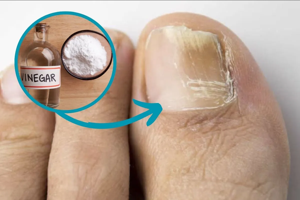Cómo utilizar el vinagre para eliminar los hongos en las uñas de los pies