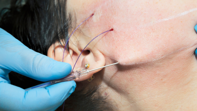 Resultado fios de sustentação