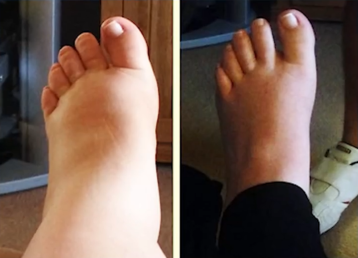 woman showing relief after swollen feet reduced