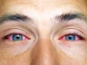 person-with-red-eyes-300x225-1.jpg