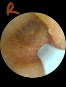 Right-inner