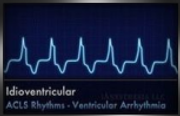 idioventrictular