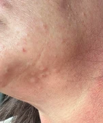 sudden-itchy-bumps-on-face-that-fill-with-clear-fluid-and-v0-br5d5t81dztg1