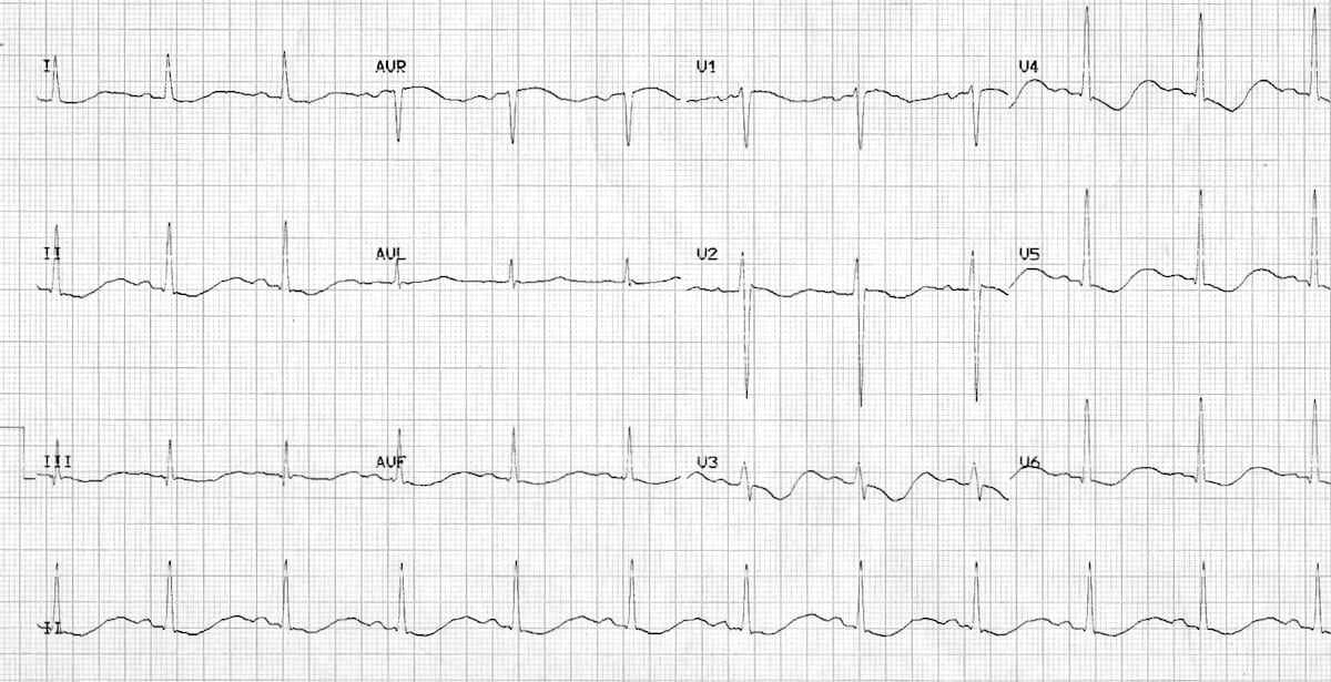 ECG showing Hypokalemia – U waves, ST depression, prolonged QT