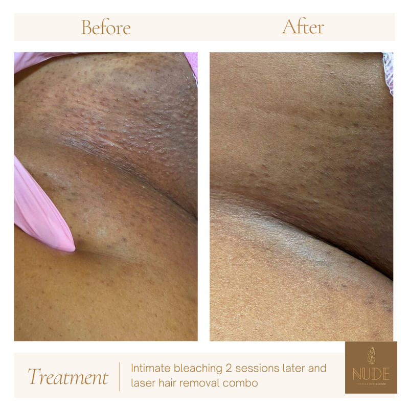Laser Hair Removal Result