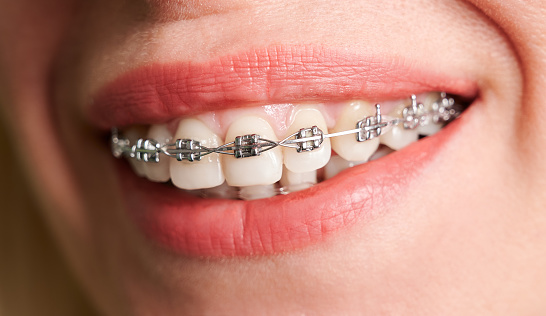 Can You Drink Soda With Braces? A Dentist’s Practical Guide