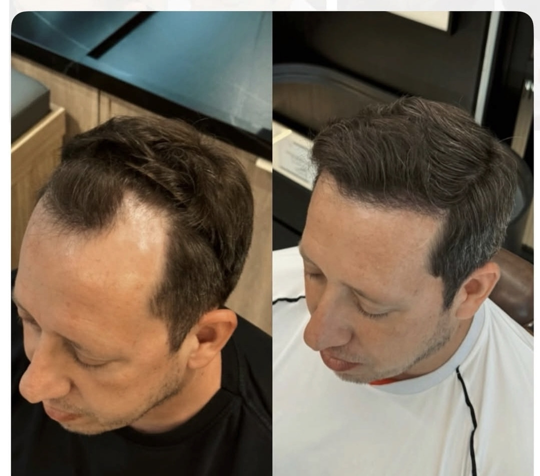 Resultado de transplante capilar 1