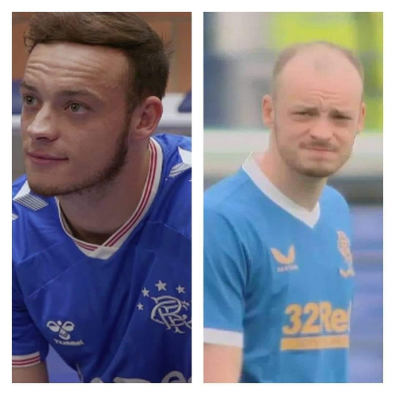 Has Brandon Barker had A Hair Transplant? Before & After Picture - Everything To Know About Rangers FC Player