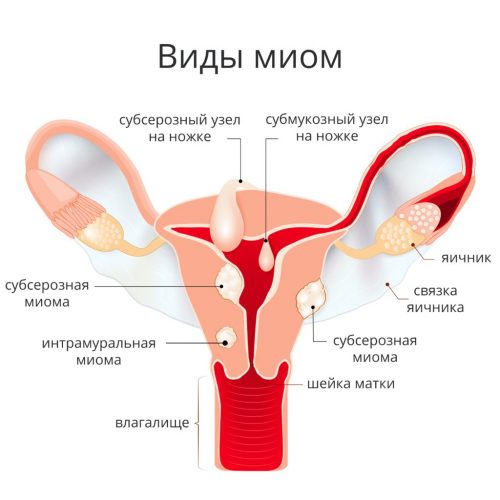 Миома матки — (клиники Di Центр)