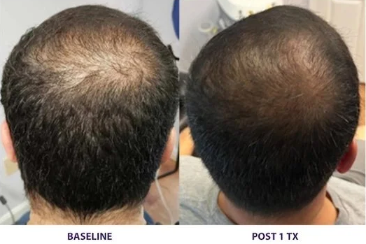 Alma TED hair restoration before and after at Let's Face It Med Spa in Denver.