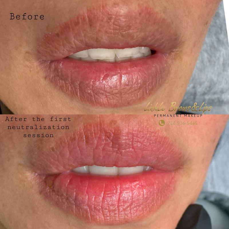 Lip Enhancement Example 5