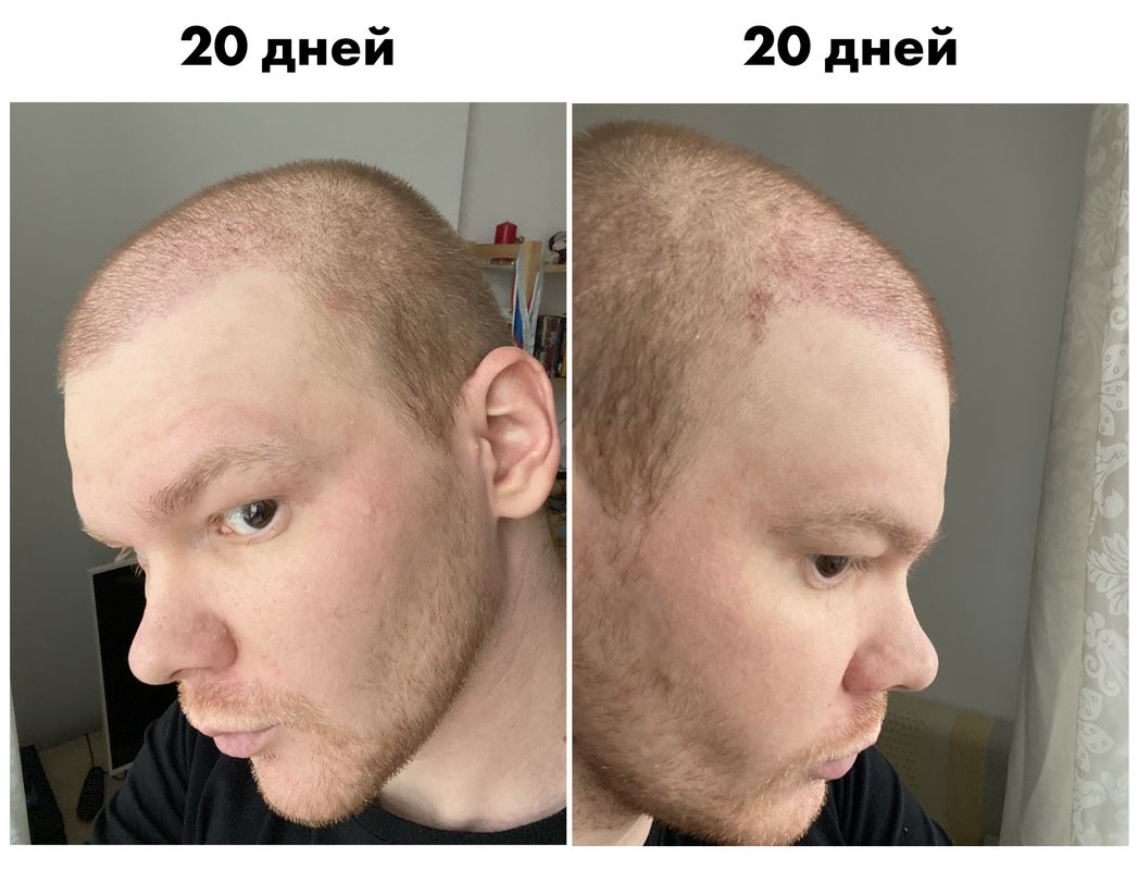 Пересадка графта. Графт трансплантация волос. До и после пересадки волос. Трансплантация волос до и после.
