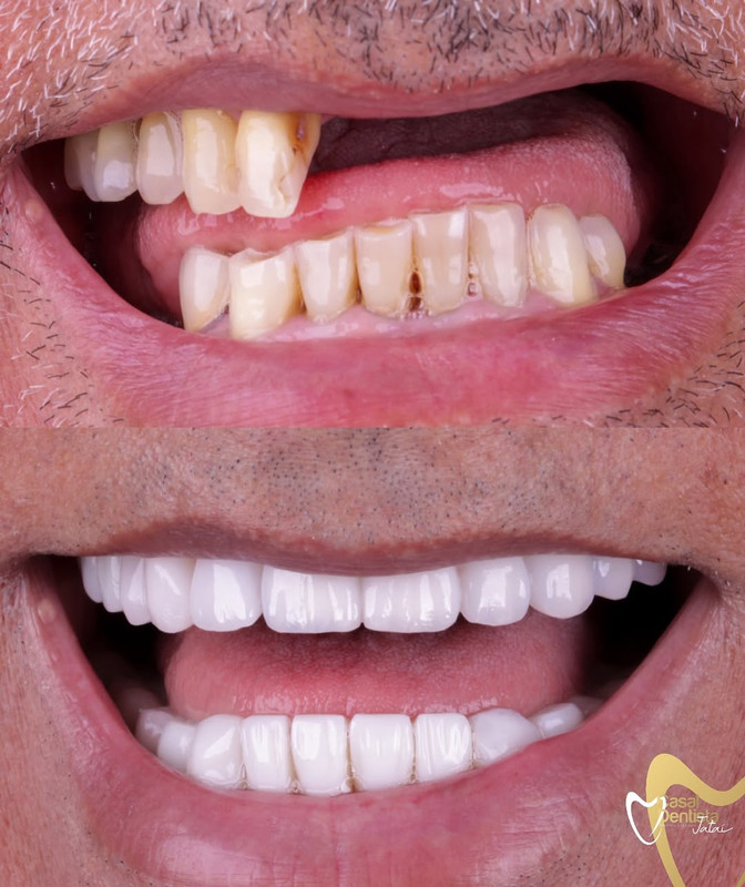 Resultado Implante 02