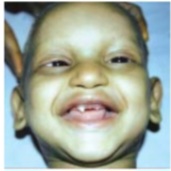 Clinical photograph showing conical (pegged) teeth, sparse hair, and characteristic facial features of hypohidrotic ectodermal dysplasia