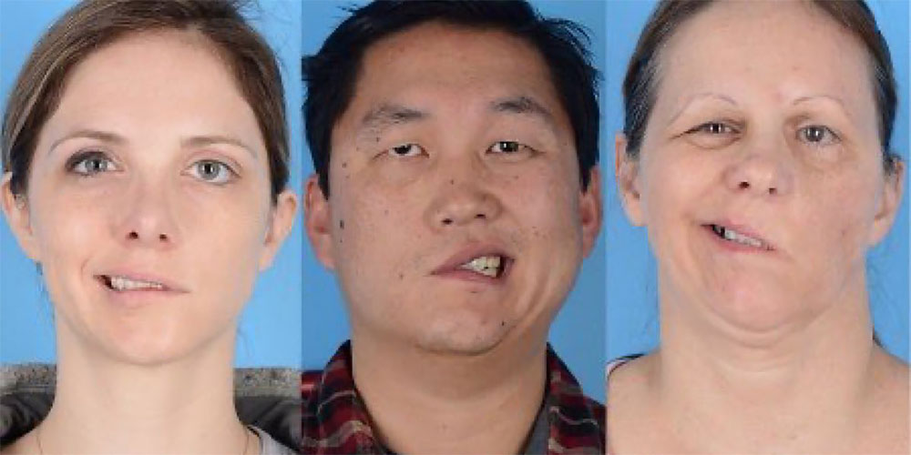 Pfizer-Bells-Palsy-cases.jpg