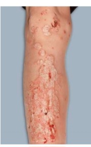 Well-demarcated erythematous plaques with thick silvery-white scales on the elbows - plaque psoriasis