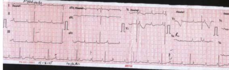 ECG showing Third-Degree (Complete) Heart Block – AV dissociation, P waves independent of QRS