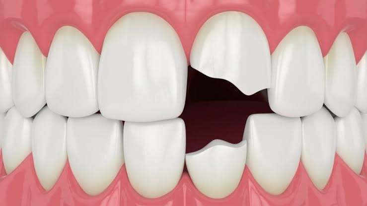 How to Fix a Chipped Tooth: A Comprehensive Guide to Restoring Your Smile