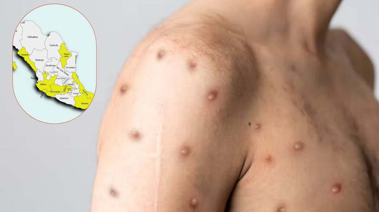 Actualización de casos de viruela del mono en México