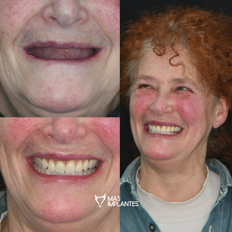 Antes y después de implantes dentales en paciente