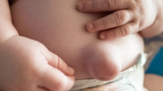 Umbilical hernia - protruding swelling at umbilicus during crying