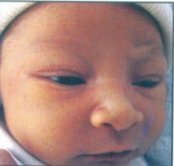 Neonatal milia – small white papules on face