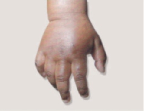 Clinical photograph showing bilateral swollen, tender hands and feet (dactylitis) in a child with sickle cell disease