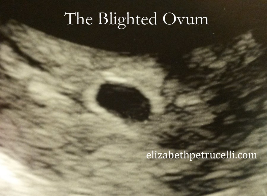 Blighted ovum
